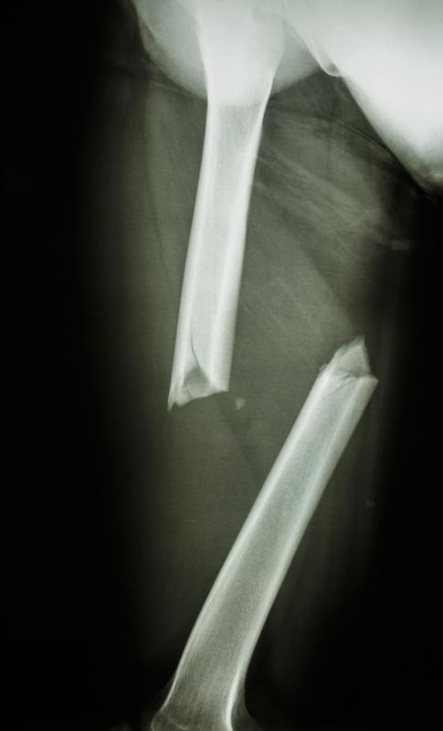 With a transverse fracture, the break is perpendicular to the way the bone runs.
