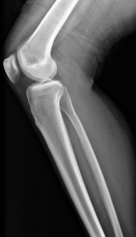 This x-ray shows the femur, patella (kneecap), tibia, and fibula.