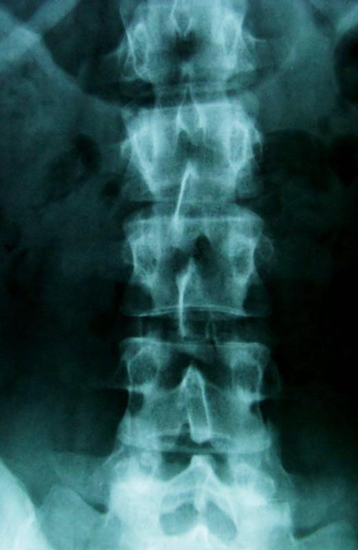 Many parts of the body, including the intervertebral disks, contain type I collagen.