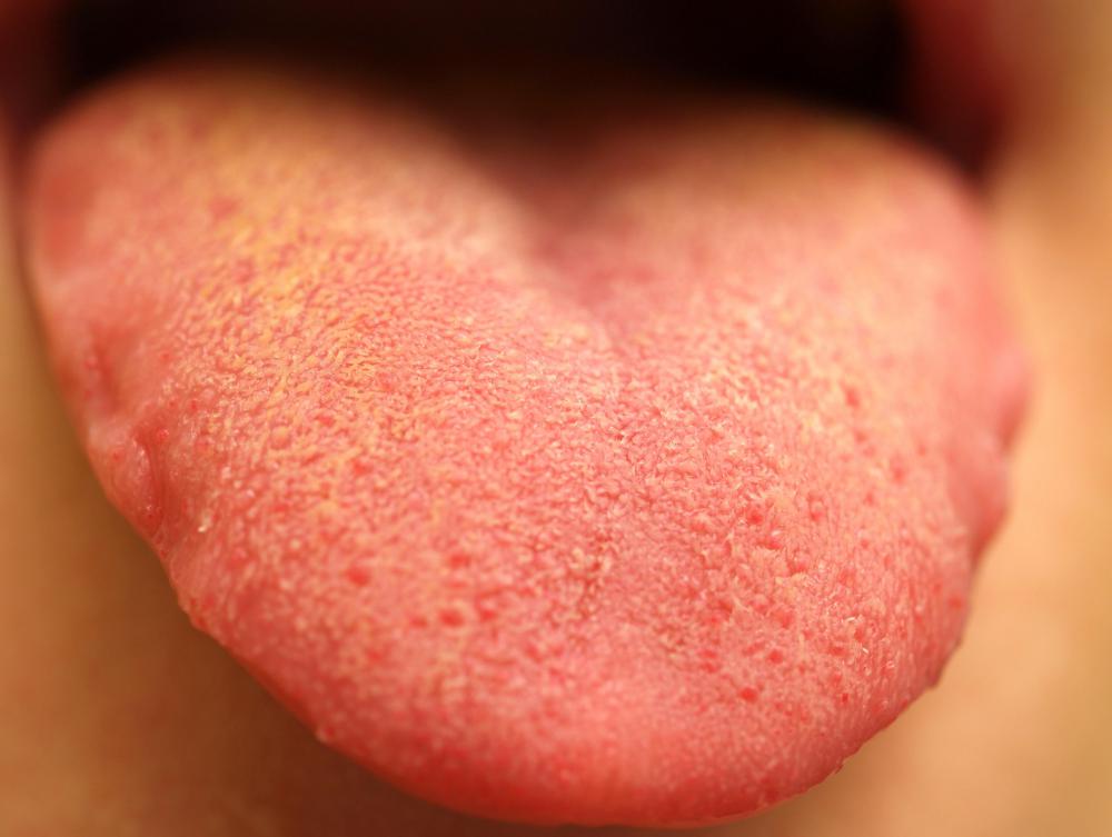 A person with yellow tongue.