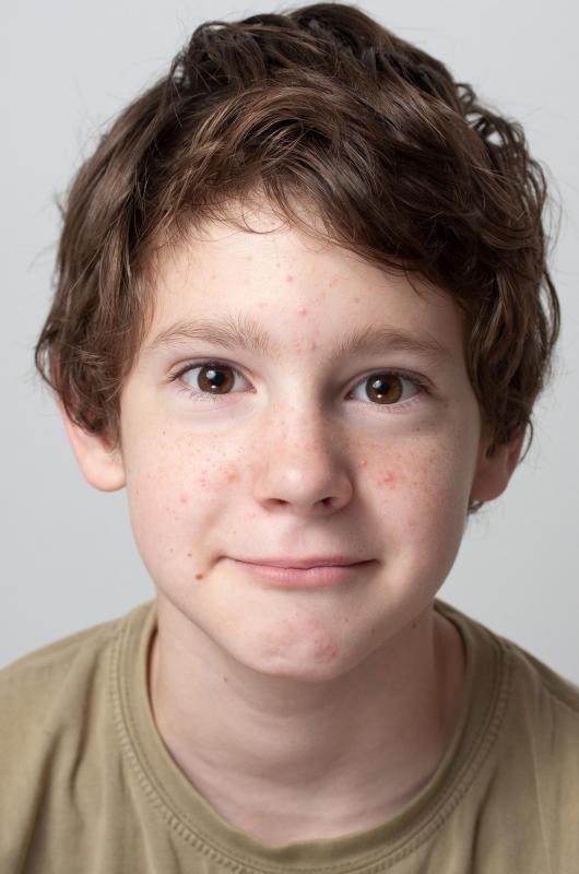 Vellus hair has no subcutaneous glands, so young children rarely experience acne.