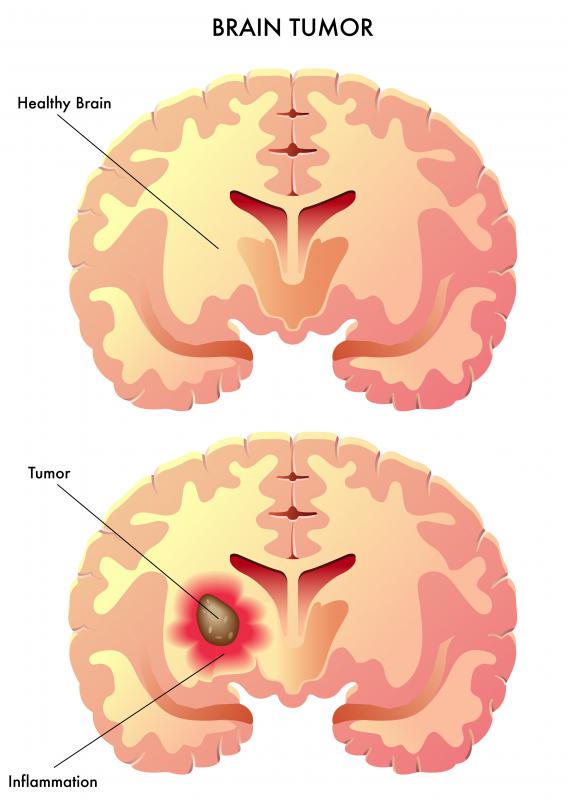 What Diseases Can Affect The Blood Brain Barrier 