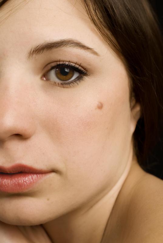 A skin mole may be flat or raised, and can sometimes sprout a few hairs.