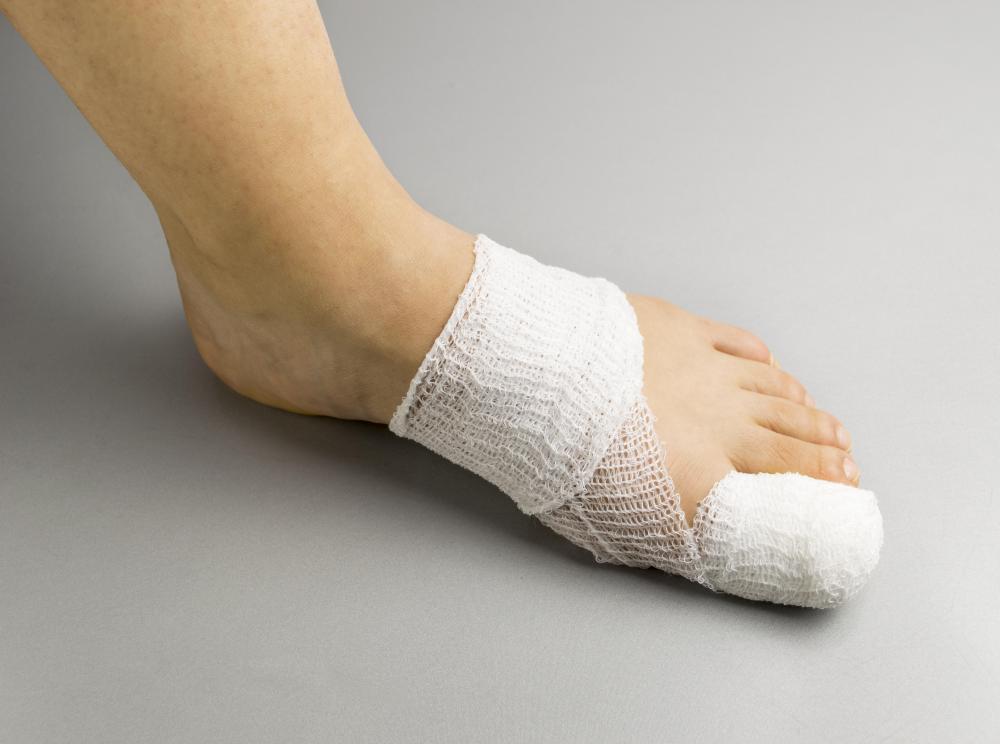 What Are the Symptoms of a Toe Stress Fracture? (with pictures)