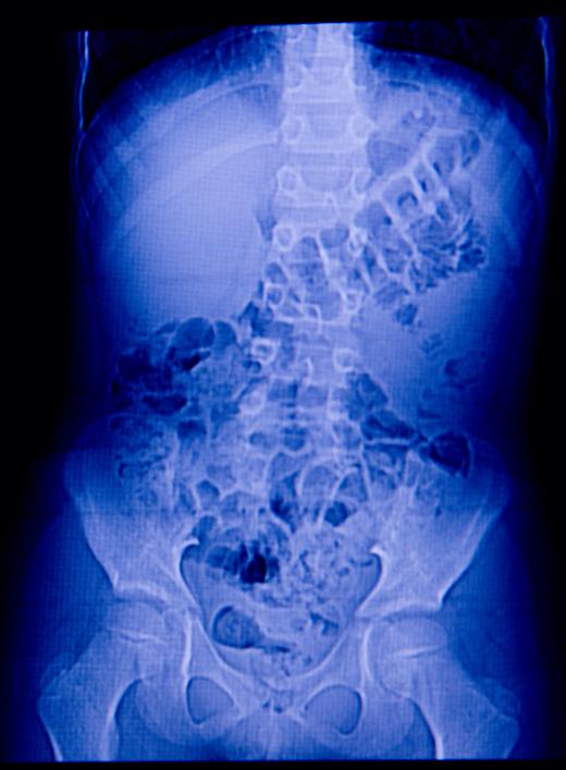 Abnormalities of the duodenum may show up on an abdominal X-ray.