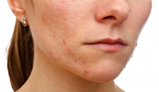 Use Fucidin to treat infected wounds and skin infections, such as acne.