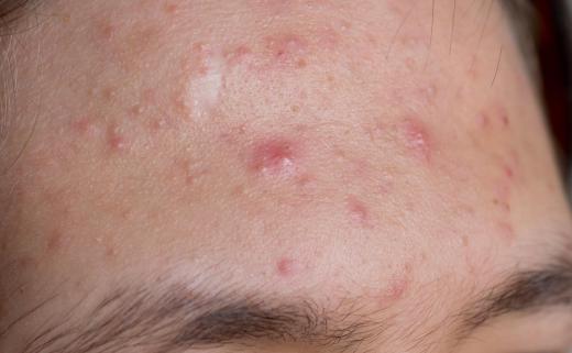 A close up of acne.