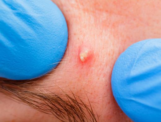 A pocket of pus may develop as a result of acne.