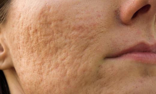 Lasers can be used to reduce acne scarring.