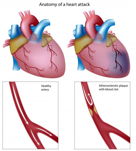 The anatomy of a heart attack. Cholesterol in the bloodstream can build up, causing coronary stenosis.