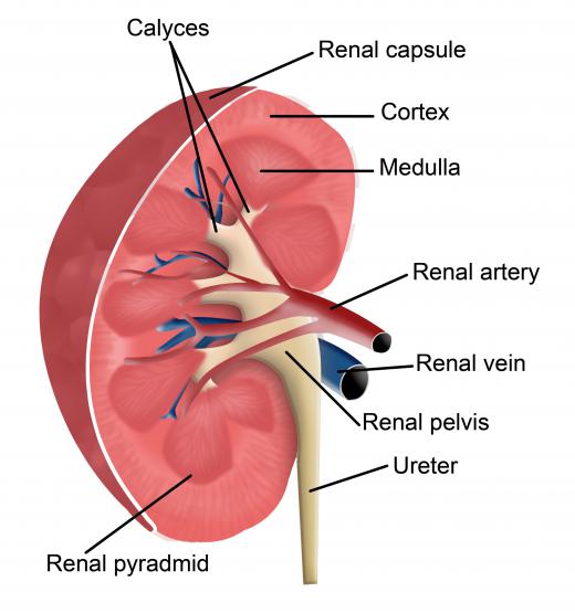 The anatomy of a kidney, including one of the renal arteries, which is narrowed in those with renal hypertension.