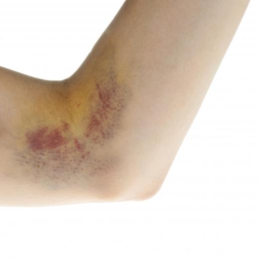 Excessive bruising is a symptom of liver failure.