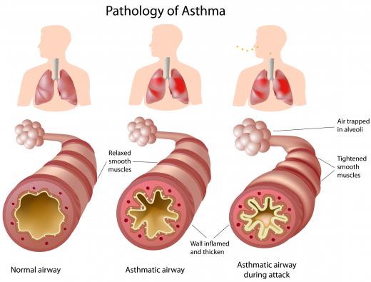 Asthma can restrict airways and cause asphyxia.