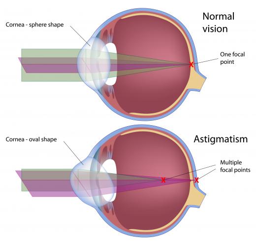 In astigmatism, the eye focuses images on more than one point rather than the single point of normal vision.