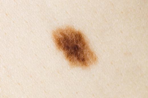 An asymmetrical mole with blurred edges.