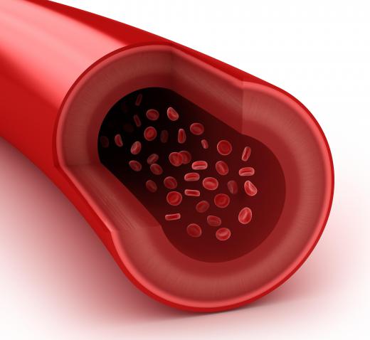 An NSTEMI is a type of heart attack that is caused by the partial or almost full occlusion of the coronary artery by a thrombus or embolus.