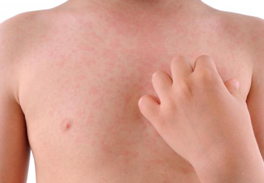 Rashes with pus may be caused by an autoimmune disease.