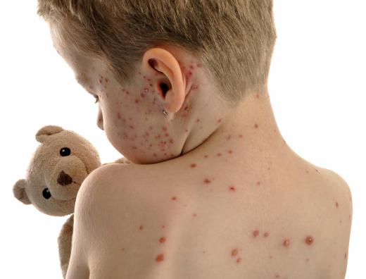 A boy with chickenpox papules.