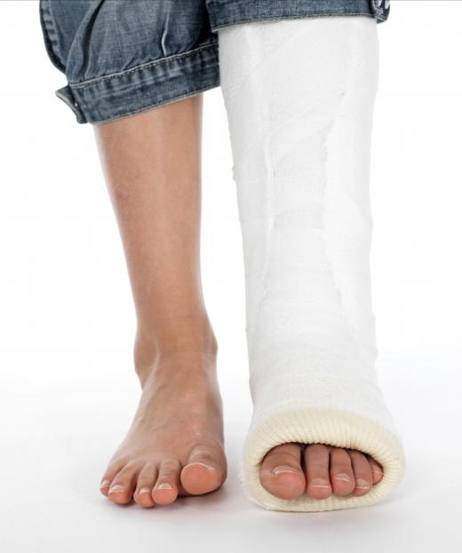 A cast is often used to treat a fibula fracture.