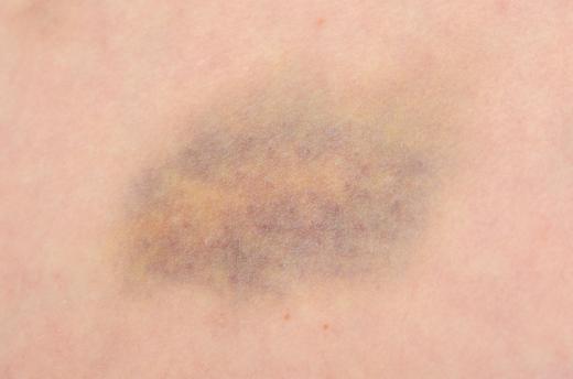 Bruising is a common stoma problem.