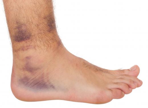 Many ankle injuries will result in bruising while they heel.