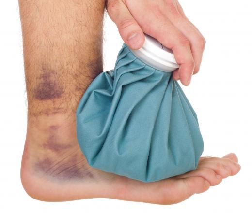 Regularly apply ice soon after injuring an ankle.