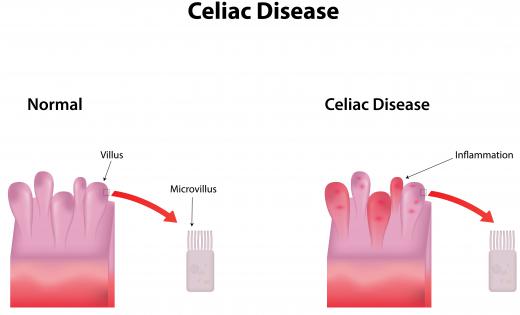 Steatorrhea may occur in celiac disease.