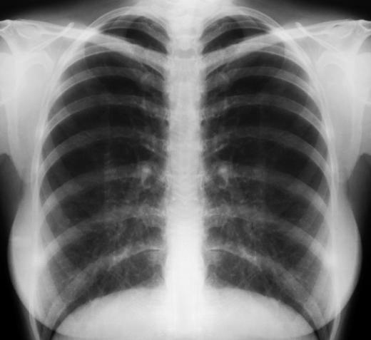 A chest x-ray can show a tumor, but won't show where it comes from or if it is cancerous.