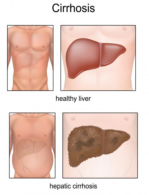 In some cases, a patient will develop cirrhosis of the liver due to having sarcoidosis.