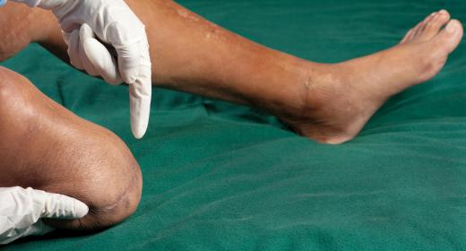 Without timely treatment to legs that experience neuropathy, a leg amputation becomes a possibility.