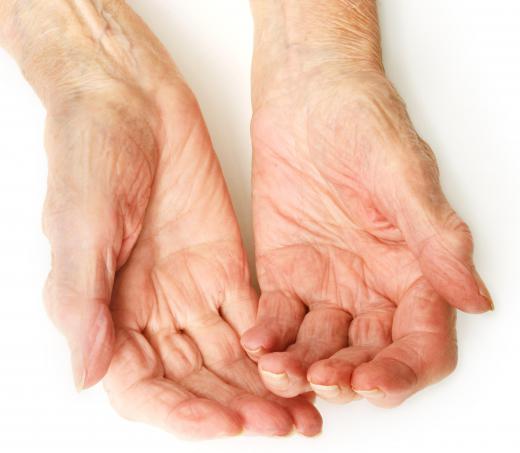 Cytotoxic drugs may be used to treat severe arthritis.