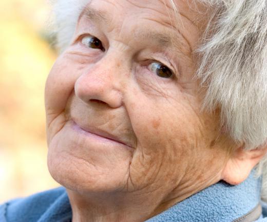 Sneddon-Wilkinson disease most commonly occurs in aging women.