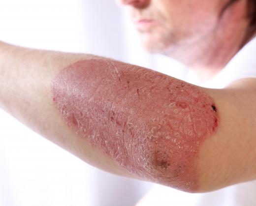 Psoriasis is a skin disease characterized by itchy, red patches of skin that are often scaly.