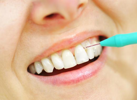 A person with gingival overgrowth may have trouble keeping their teeth clean.