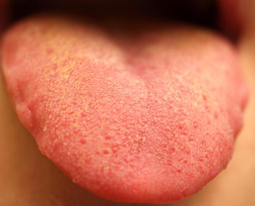 The majority of pink saliva cases can be traced to minor problems in the mouth or throat.