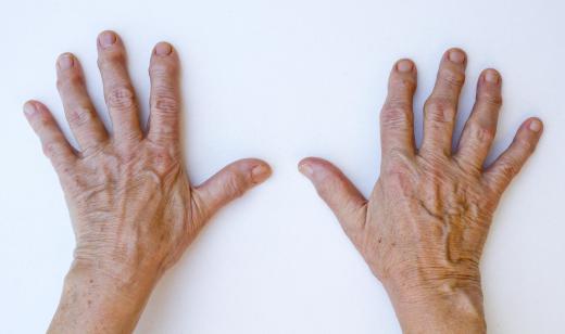 Heberden's nodes refer to swollen protrusions of bone and cartilage tissue that may develop in finger joints.