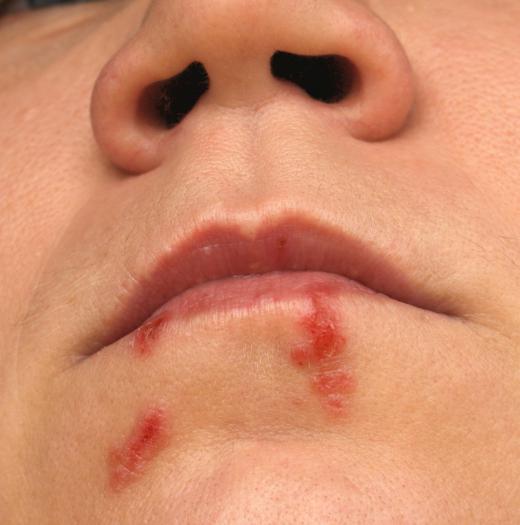 Oral herpes may result in cold sores around the mouth.