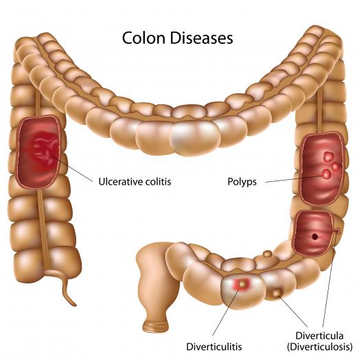 A diagram showing diverticulitis and other colon diseases.