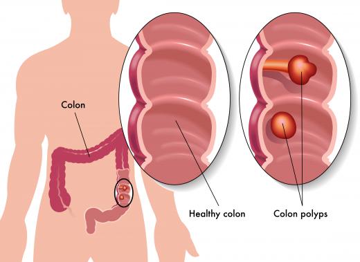 During the lower endoscopy, short puffs of air may be sent through a tube into the colon to enable the doctor to easily visualize the interior lining.