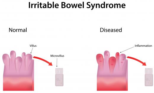 Diarrhea and constipation are two gastrointestinal symptoms that may be caused by digestive problems, such as irritable bowel syndrome.