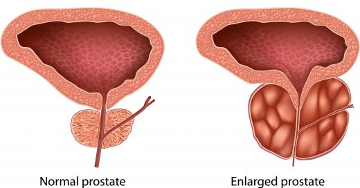 If a patient's uroflowmetry results are around 5 mL/sec, a doctor may suspect an enlarged prostate.