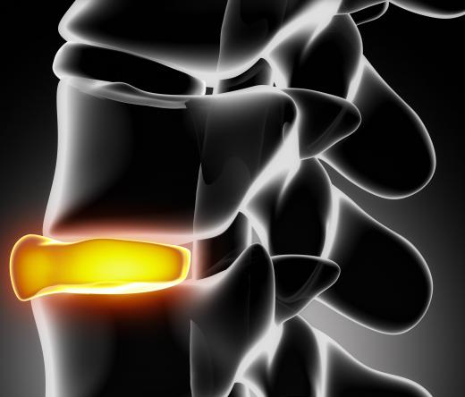 Excessive pressure on a spinal disc located between two vertebrae results in a compressed disc.