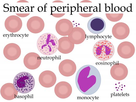 A peripheral blood smear, which is used in diagnosing atypical lymphocytosis.