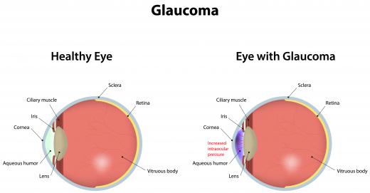 Macular edema can be caused by glaucoma.