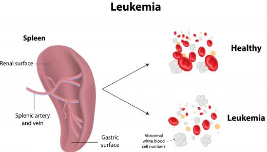 Leukemia leads to a significant increase in immature or abnormal blood cells in the body, causing the spleen to become enlarged.