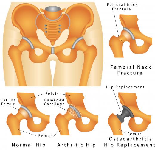 Arthritis and injury to the hip may cause bilateral hip pain.