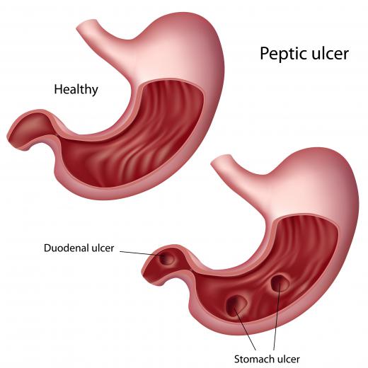 A healthy stomach and one with peptic ulcers.