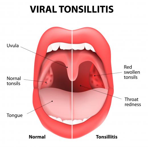 Tonsillitis may cause frontal neck pain.