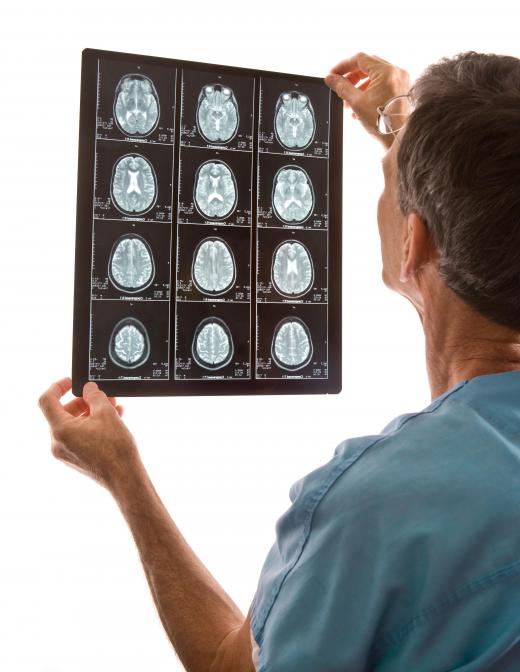 MRI brain scans can help physicians look for MS lesions.