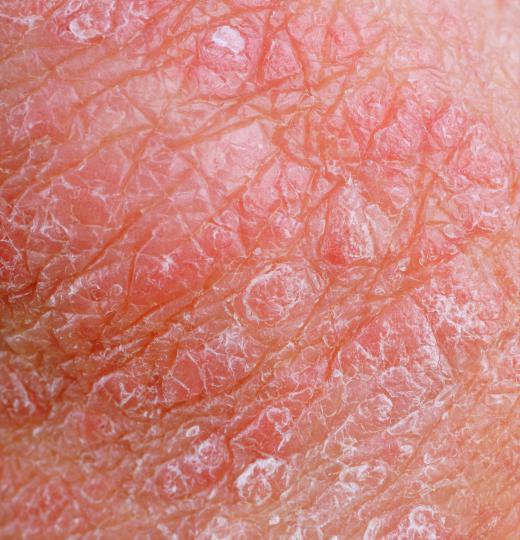 Zinc pyrithione can be used to treat eczema.